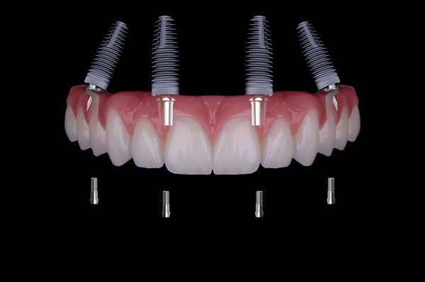 All On   Is A Minimally Invasive Solution For Missing Teeth