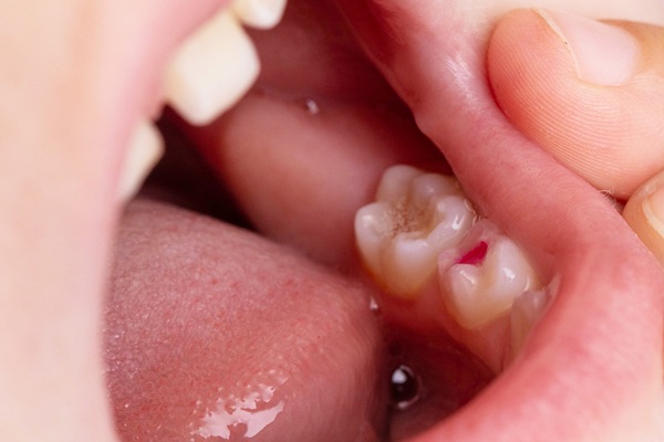 Does A Tooth Filling Hurt?